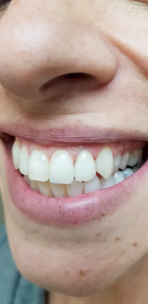 אחרי — החלפת כתר וביצוע כתר ויניר אסתטי בפגישה אחת